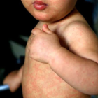El sarampión produce fiebre alta y machas rojas en el rostro y en el cuerpo.