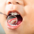 La caries dental continúa siendo una de las enfermedades más frecuentes en Ecuador, afectando especialmente a niños y escolares.