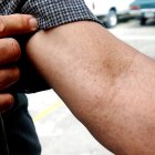 Casos de enfermedades en la piel suben 27,9% en Guayaquil en 2026.