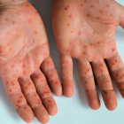 Erupciones o lesiones cutáneas aparecen en la cara, las palmas de las manos y las plantas de los pies en casos de viruela símica o mpox.