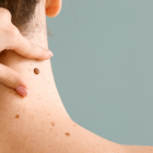 Moderna y Merck anunciaron resultados positivos de una terapia personalizada de ARNm contra el melanoma.